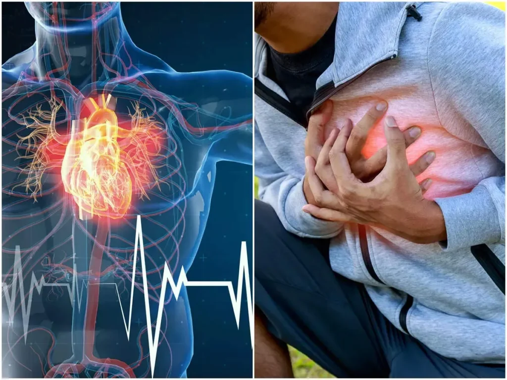 heart attack